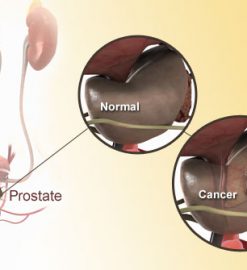 Beberapa Panduan Untuk Penyakit Kanker Prostat